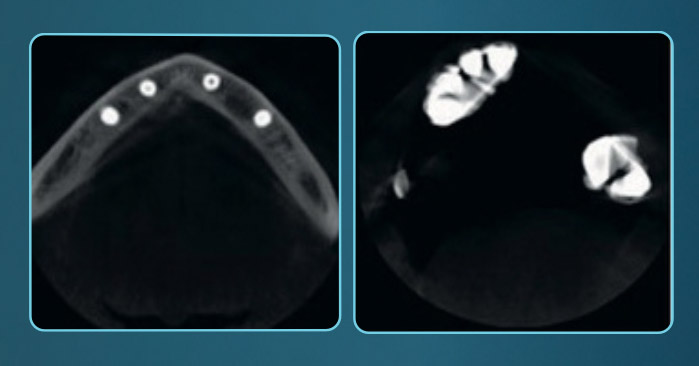Metal artifact reduction - MAR. With the reduction of artifacts.